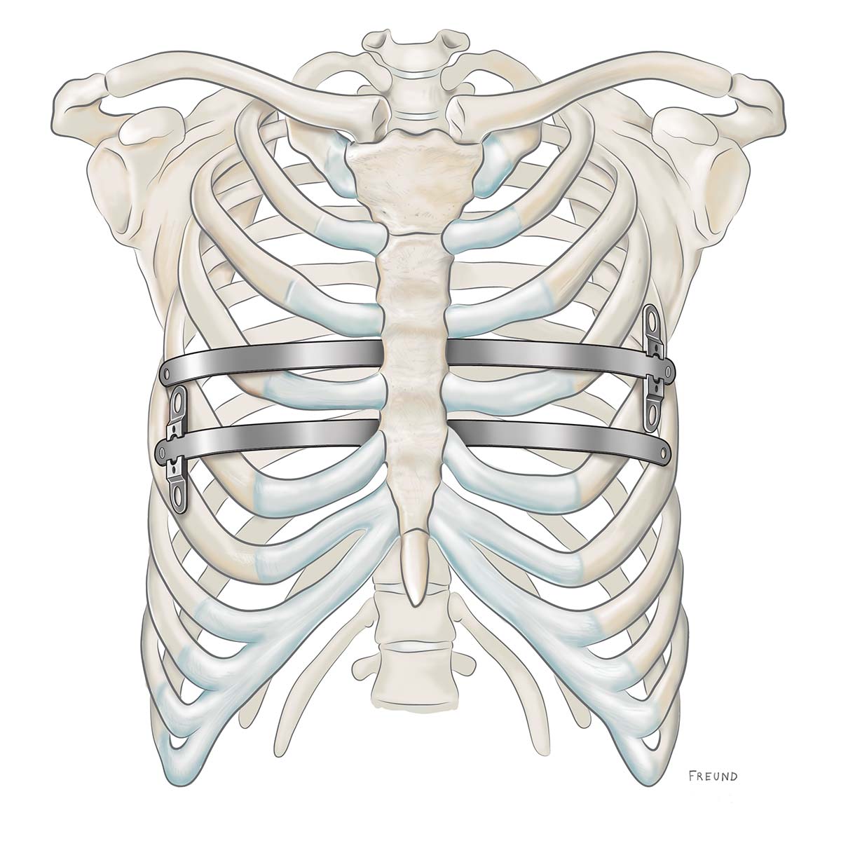 Pectus Excavatum PES MedXpert