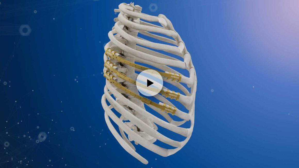 MedXpert The chest wall company